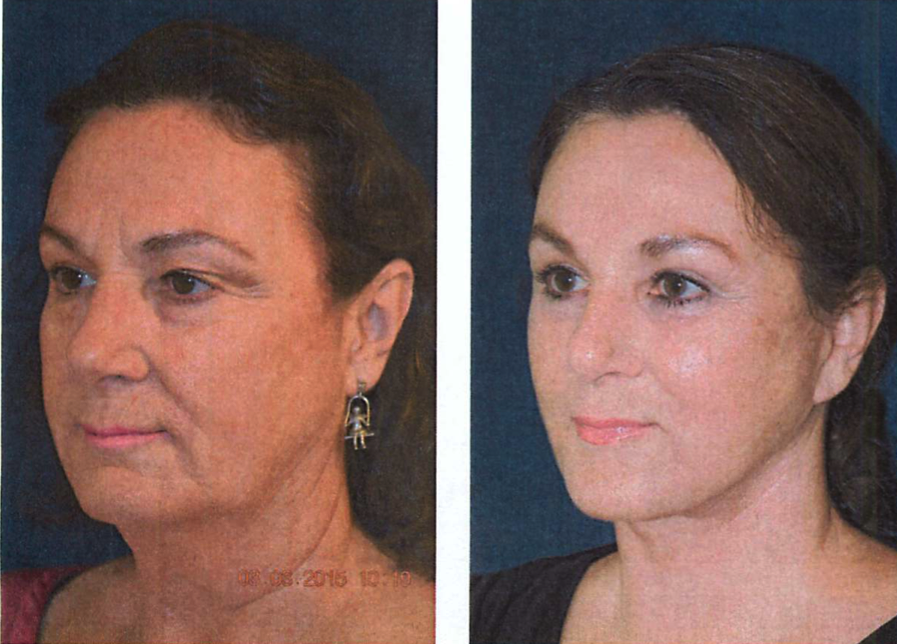 Judy facelift.png